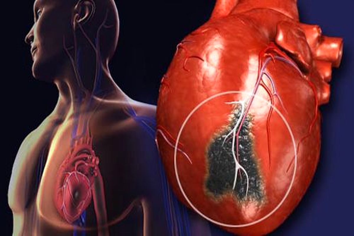تفاوت علائم سکته قلبی در مردان و زنان