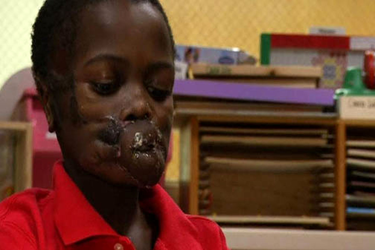 عمل جراحی ۱۴ ساعته کودکی که شامپانزه‌ها به او حمله کرده بودند