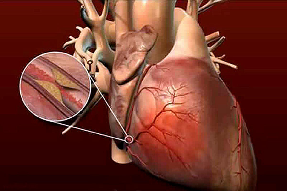 بیماری عروق کرونری از زوایای مختلف بررسی می‌شود
