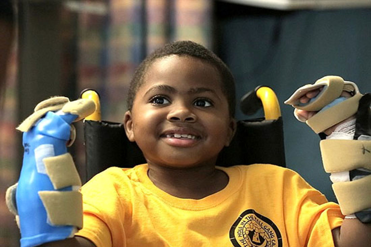 موفقیت اولین جراحی پیوند دو دست جهان روی یک کودک