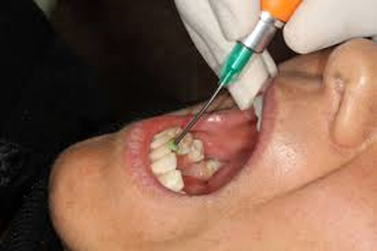 بهبودی عفونت دندان با بهره‌گیری از نانوالماس