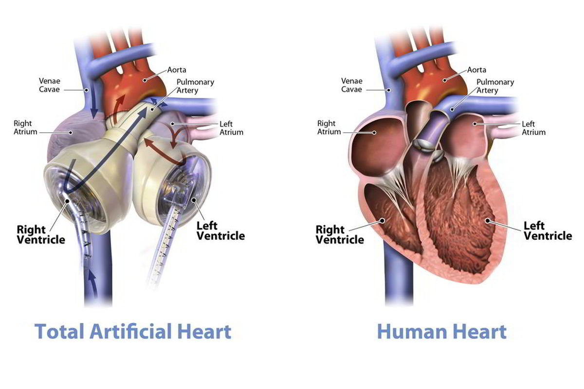 شارژ بیسیم قلب مصنوعی در دانشگاه سمنان اختراع شد