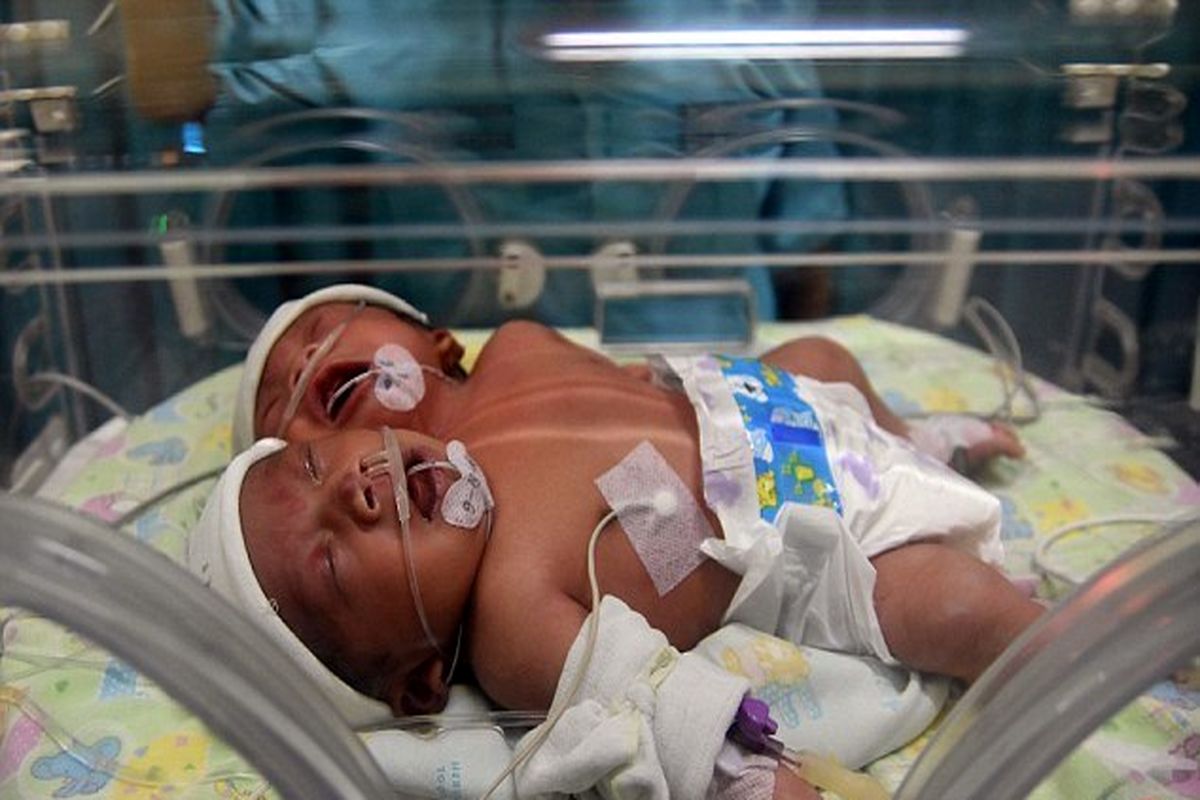 تولد یک نوزاد ۲ سر در اندونزی+ببینید