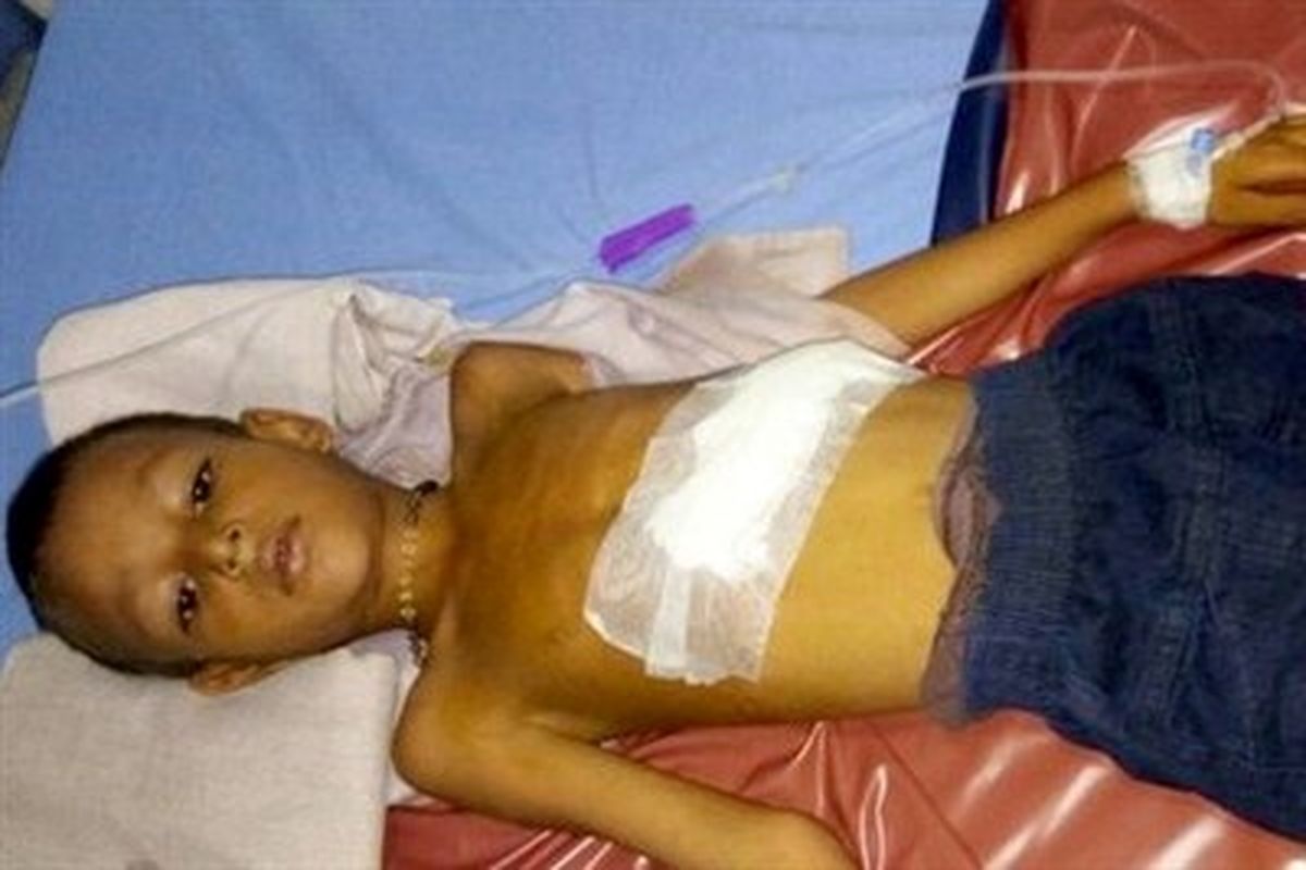 جنین دوقلو در بدن یک کودک