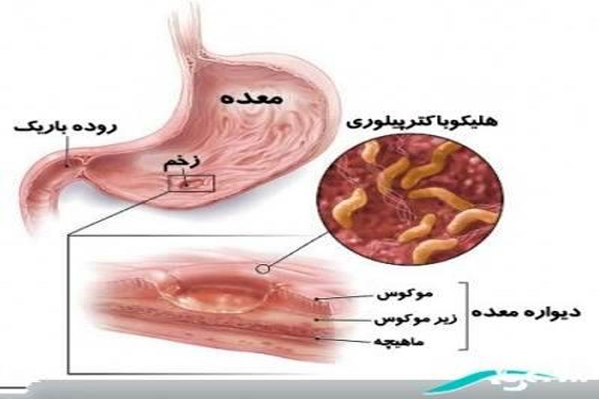 درمان زخم معده و پیشگیری از آن