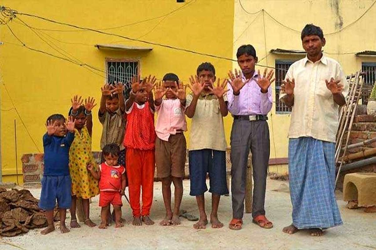 جهش ژنتیکی ۱۰۰ انگشت به خانوادۀ هندی اضافه کرد!