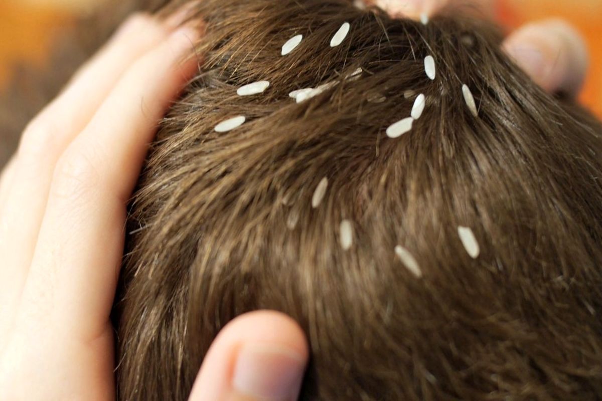 بهترین و سریع ترین روش درمان شپش موی سر