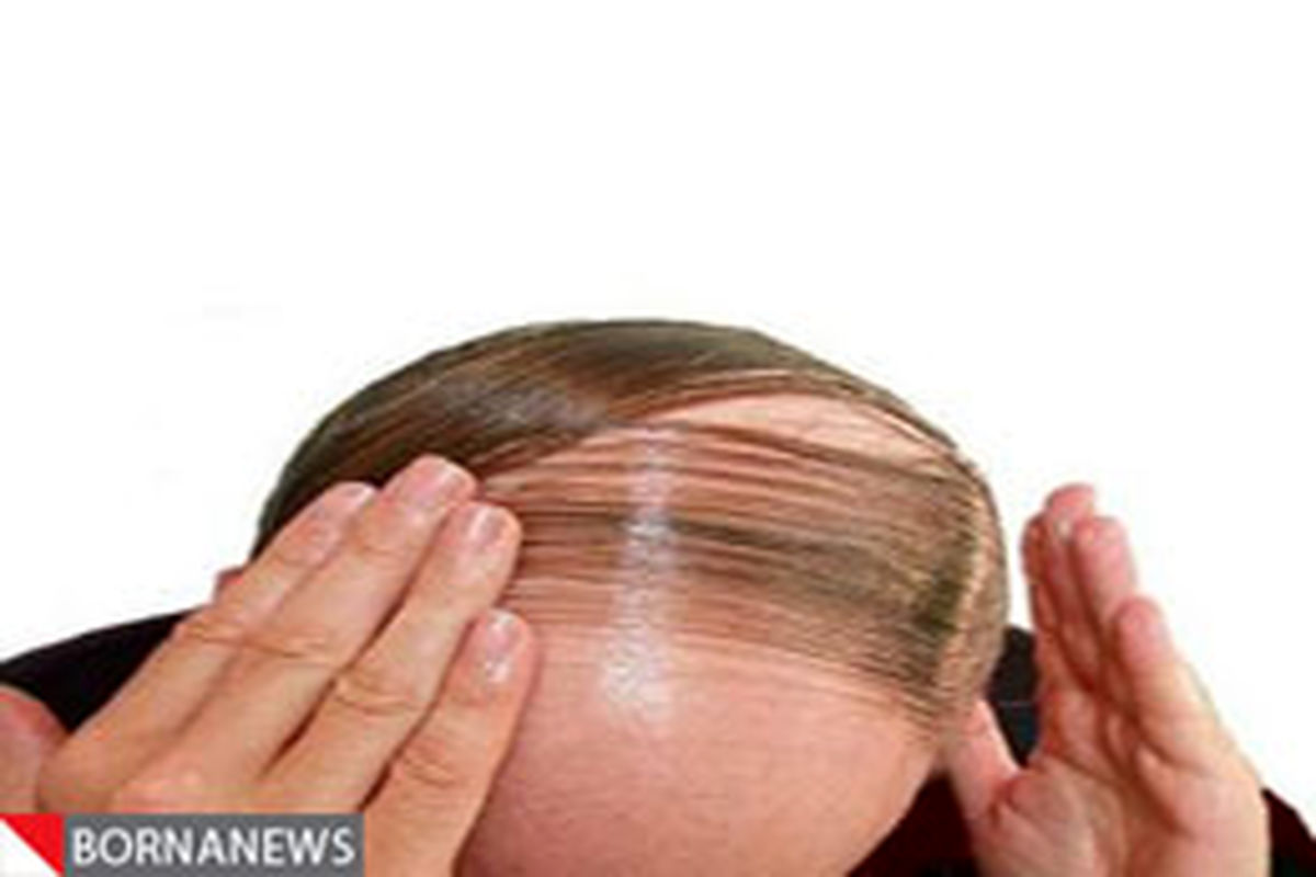 عوامل اصلی ریزش مو