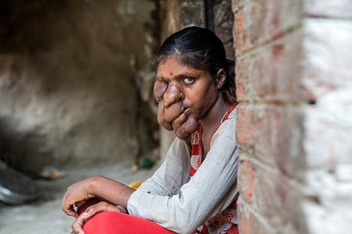 چهره عجیب دختر هندی به دلیل بیماری ژنتیکی
