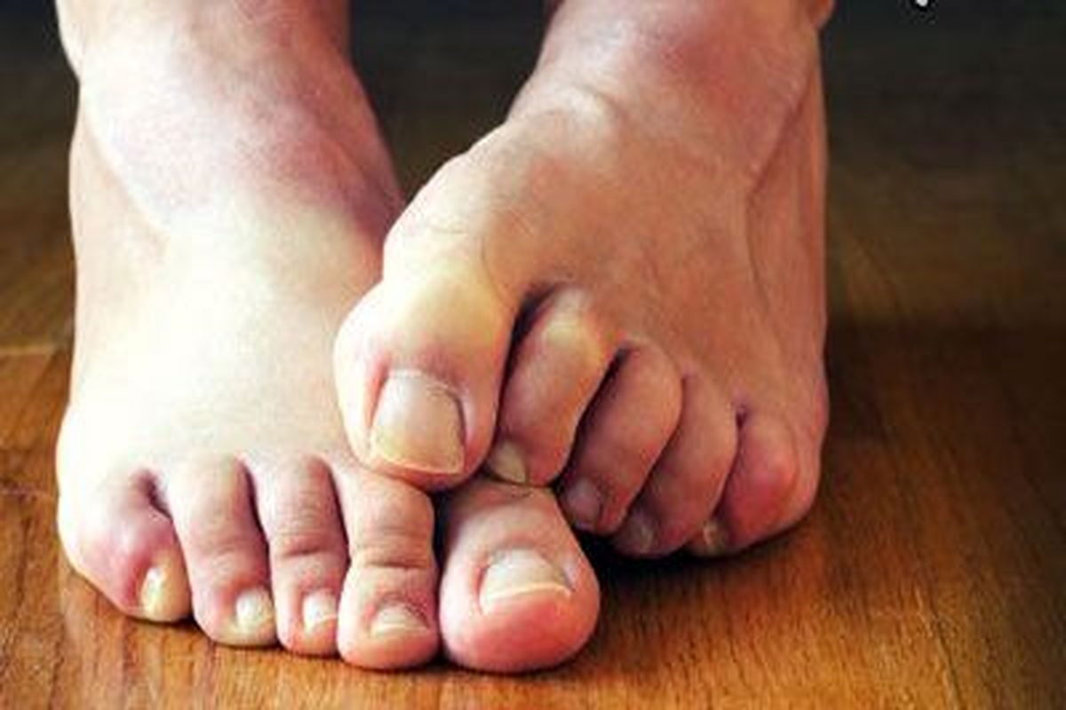 درمان ترک‌های پا