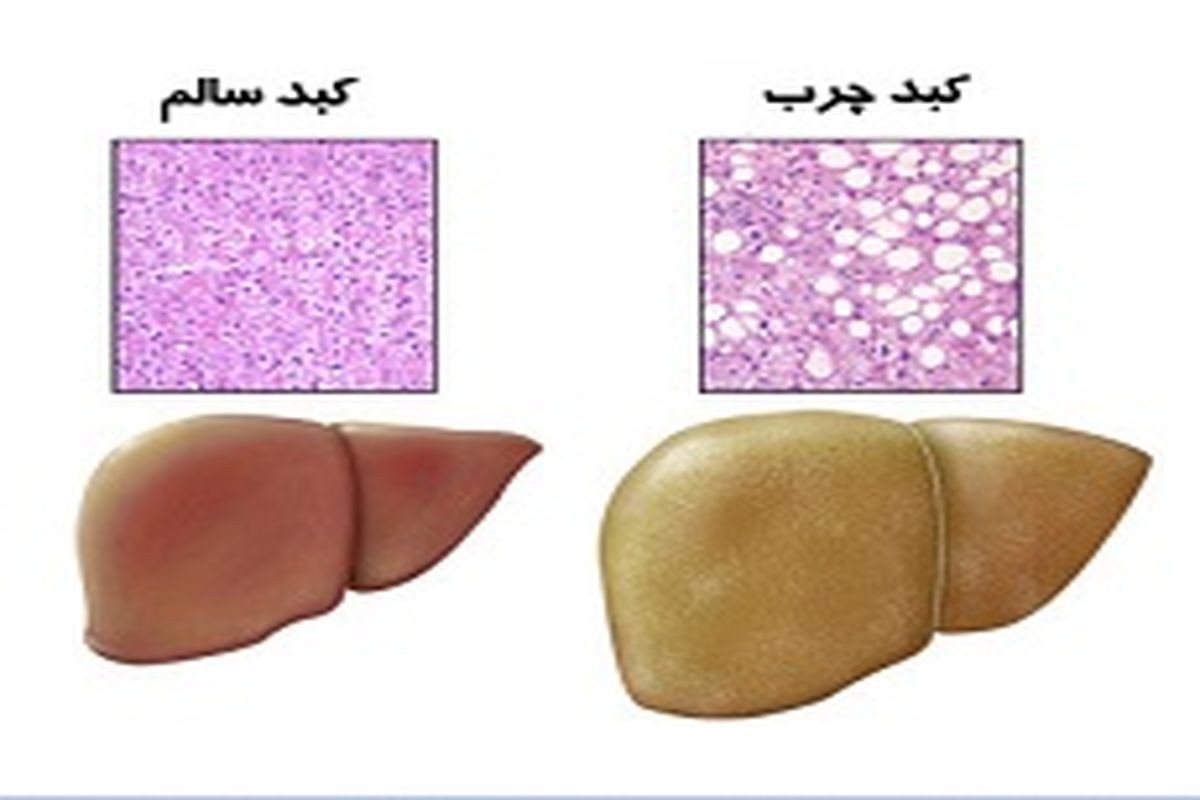 شیوع بالای سوءهاضمه و کبد چرب در ایرانی‌ها