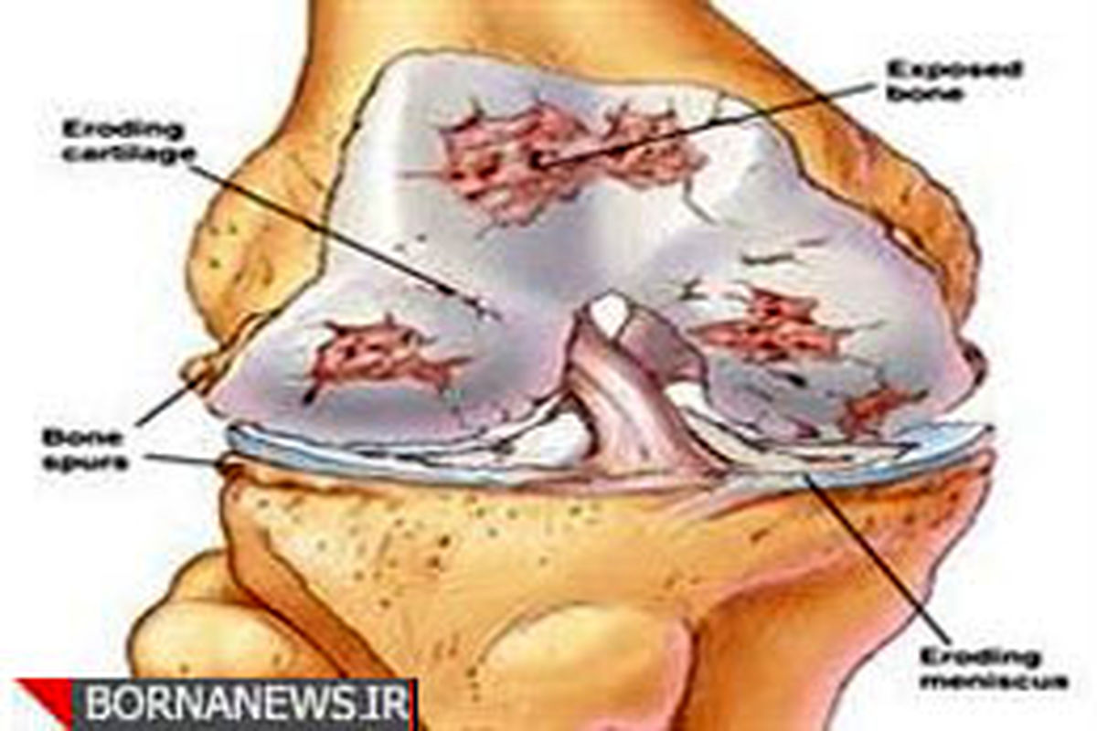 کمیاب شدن پروتز مفصل در کشور / کاهش جراحی تعویض مفصل در بیمارستان‌های دولتی