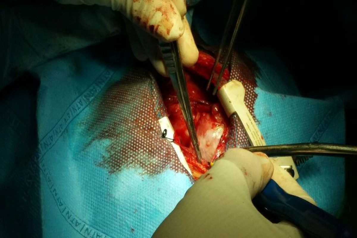 جراحی موفق خروج تومور قلبی در سمنان