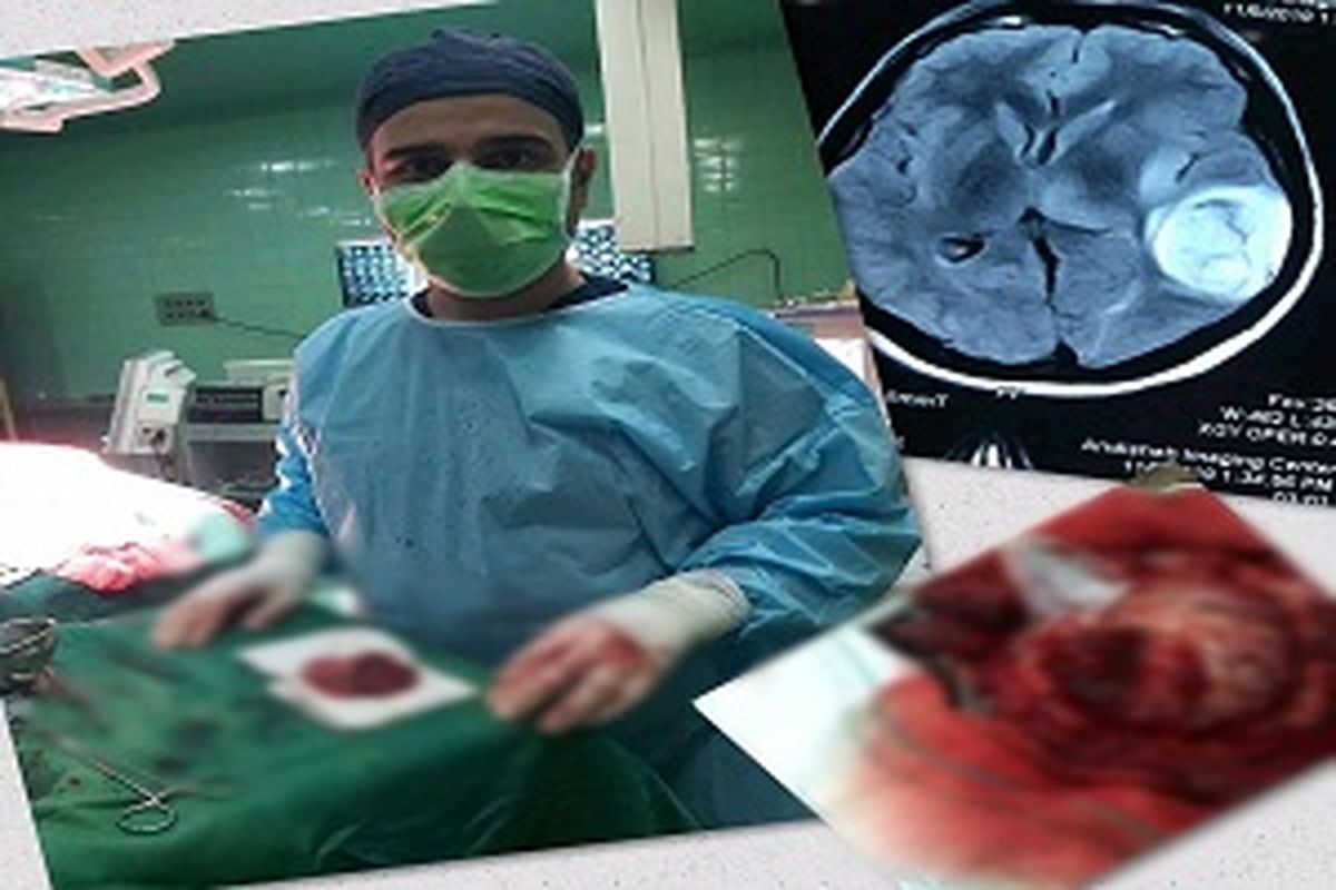 انجام اولین جراحی تومور مغزی در بوکان