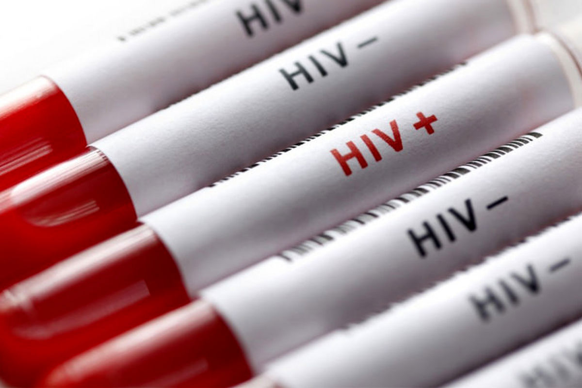 وضعیت پیوند در مبتلایان به اچ آی وی
