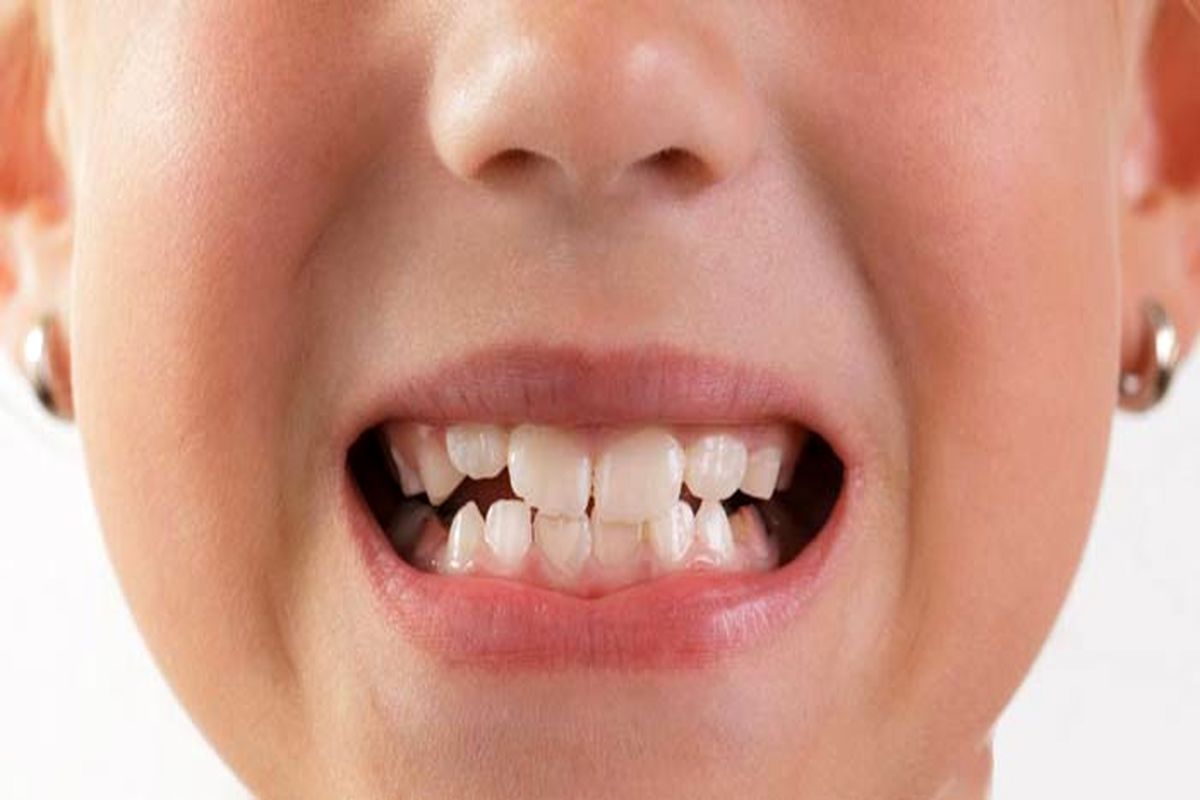 دلایل دندان قروچه کودکان؟