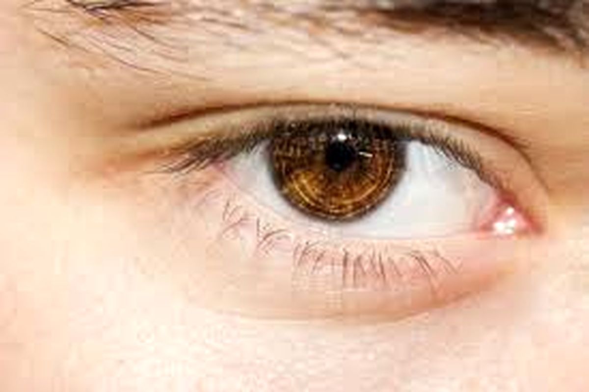 راه‌های درمان پف صبحگاهی چشم ها