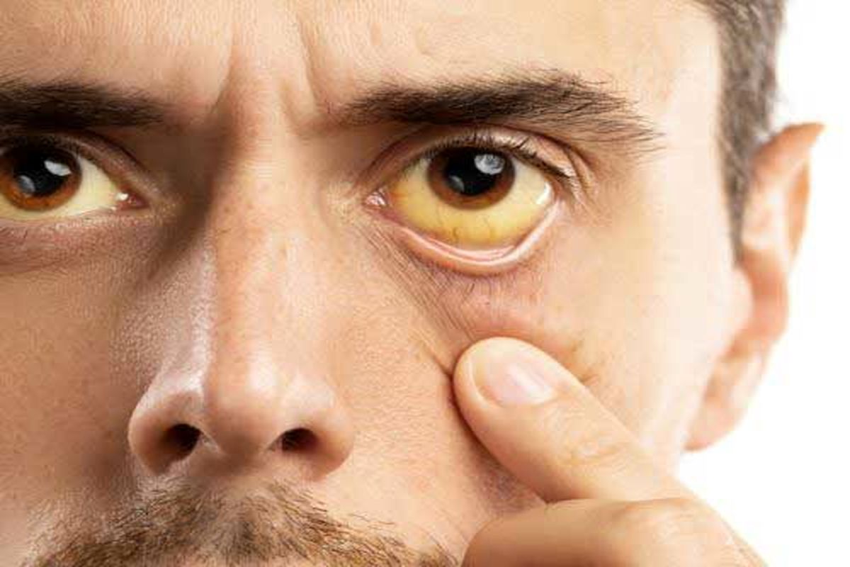 علائم مشکلات کبد را بشناسید/ اگر چشمان زردی دارید، ممکن است کبدتان بیمار باشد