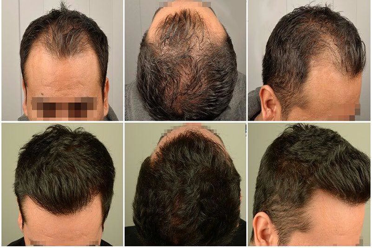 درمان ریزش مو و کاشت مو در کلینیک تخصصی رنسانس