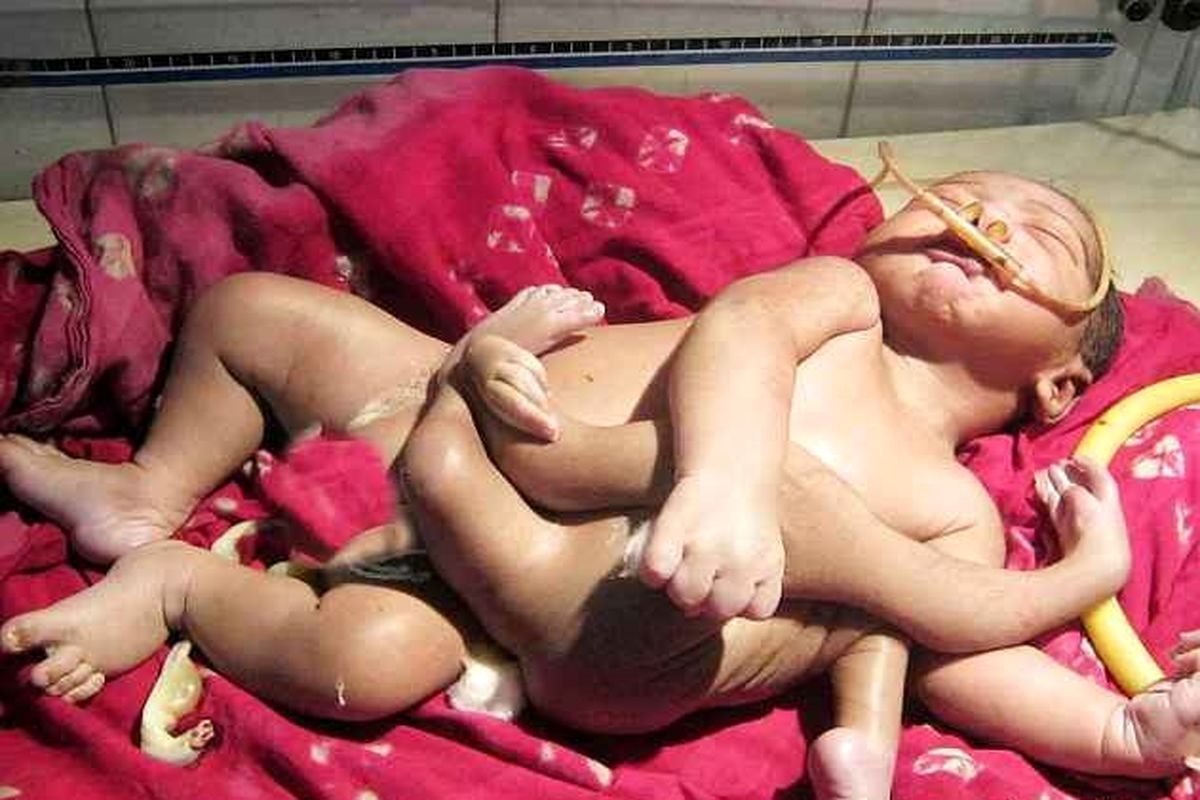 تولد نوزادی با هشت دست و پا + عکس
