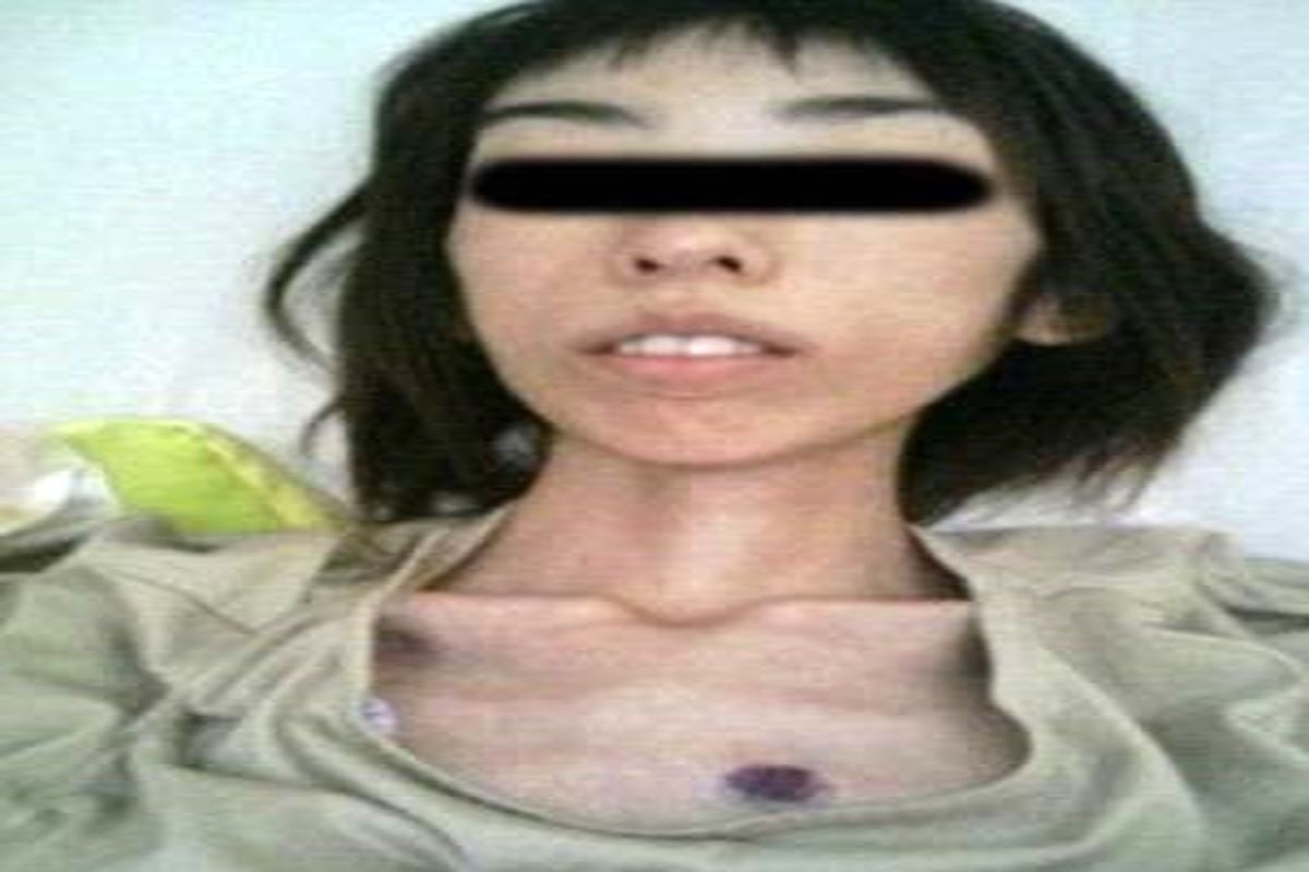 شکنجه دخترجوان او را به اسکلت ۱۶ کیلویی تبدیل کرد+ عکس