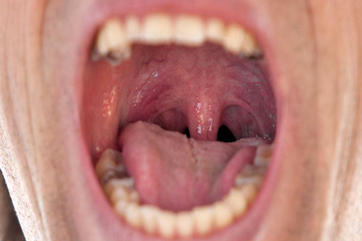 علائم خطرناکی در دهان که از ابتلا به سرطان خبر می‌دهند