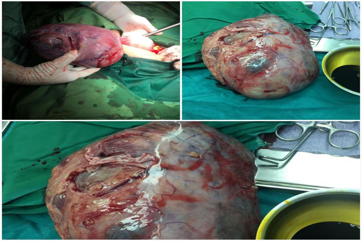 جراحی و خروج توده ۲۰ سانتی متری از شکم یک زن در قم
