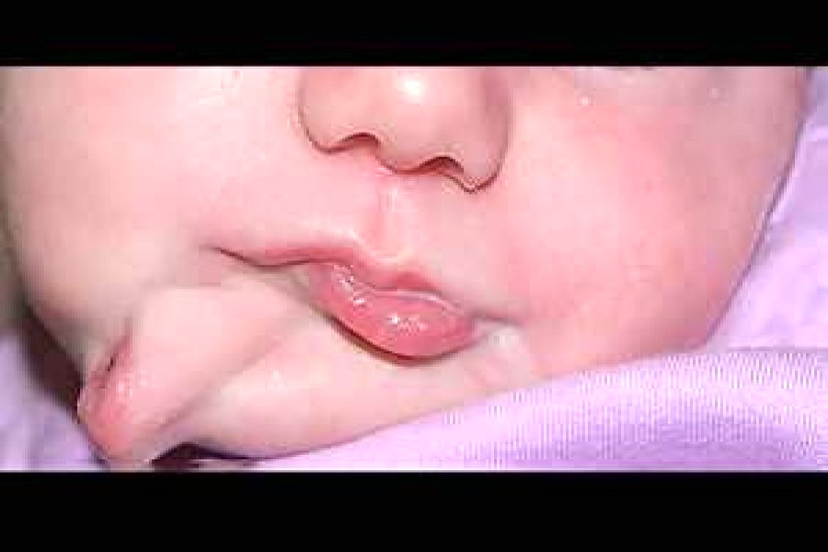 تولد یک نوزاد عجیب با دو دهان مجزا + عکس