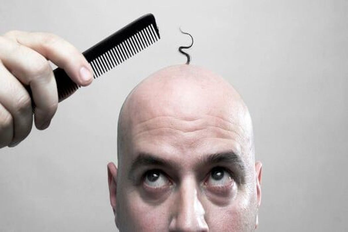 بازگشت ۹۰ درصد موی افراد طاس در دو هفته!