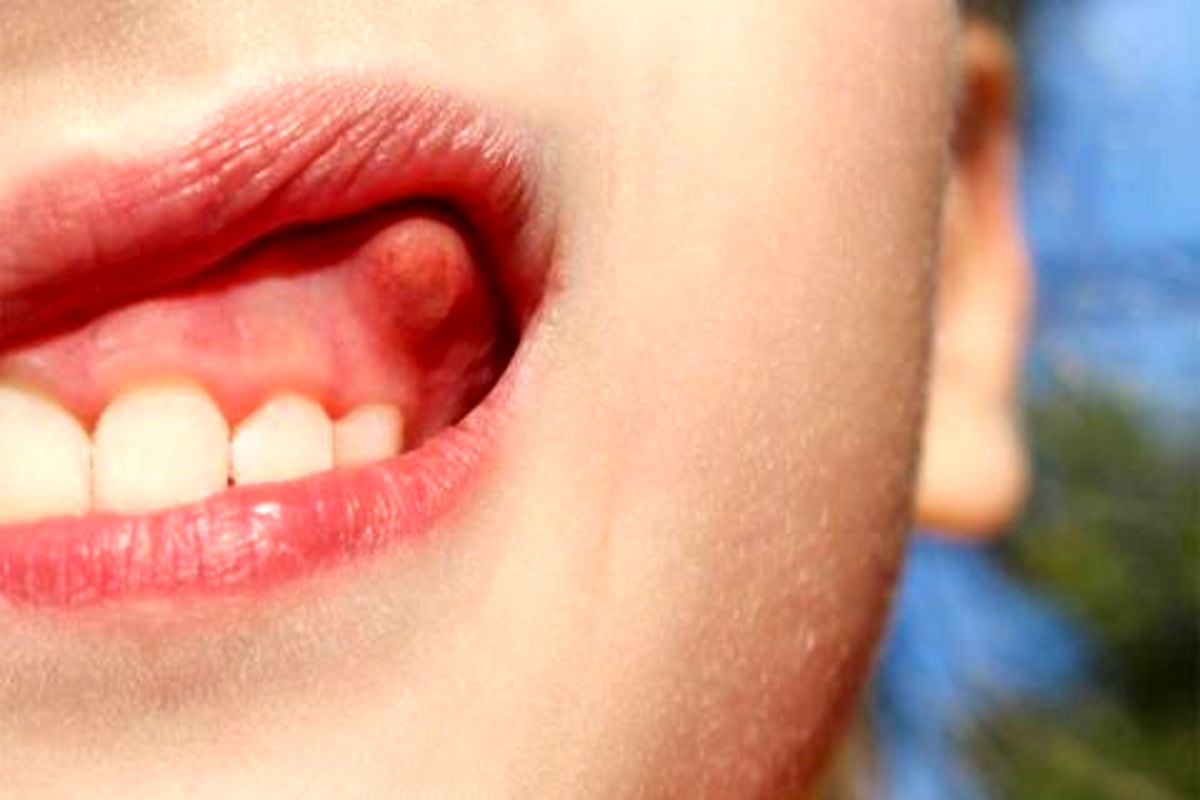 عفونت دندان خود را سه سوته درمان کنید!