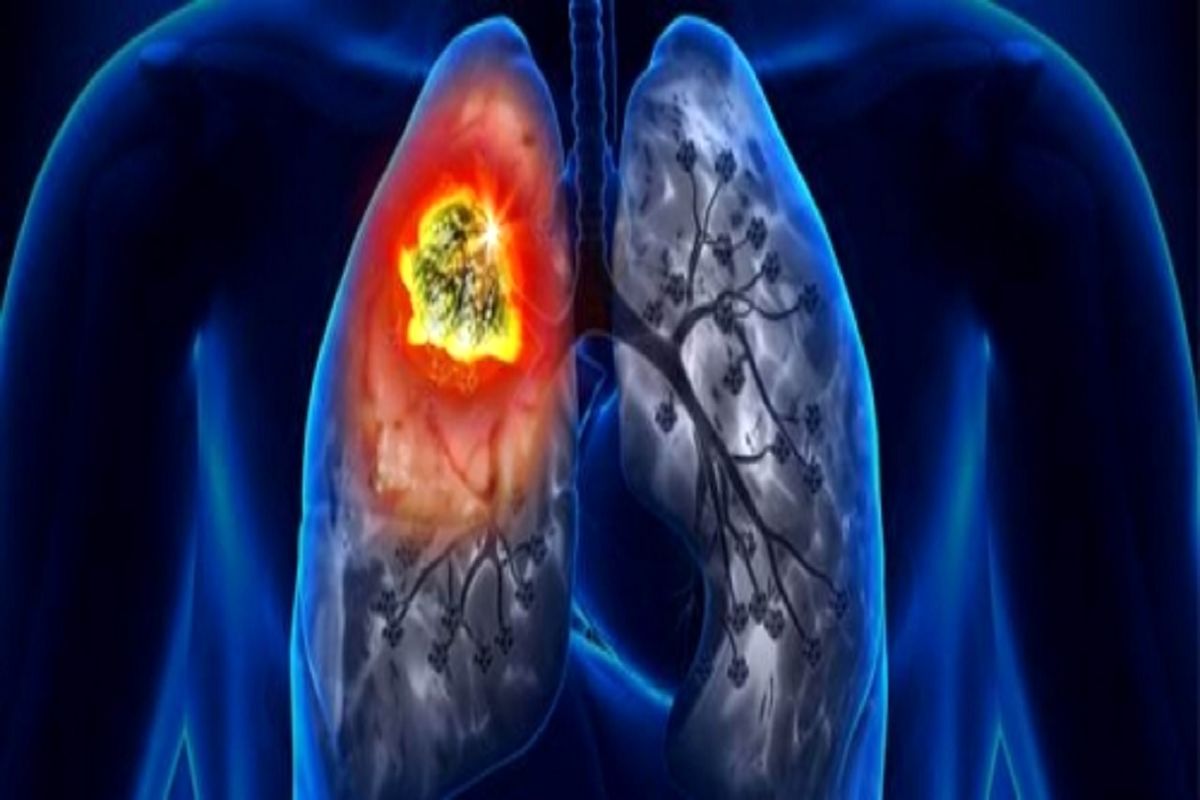 کشف یک راه جدید برای شناسایی زودهنگام سرطان ریه