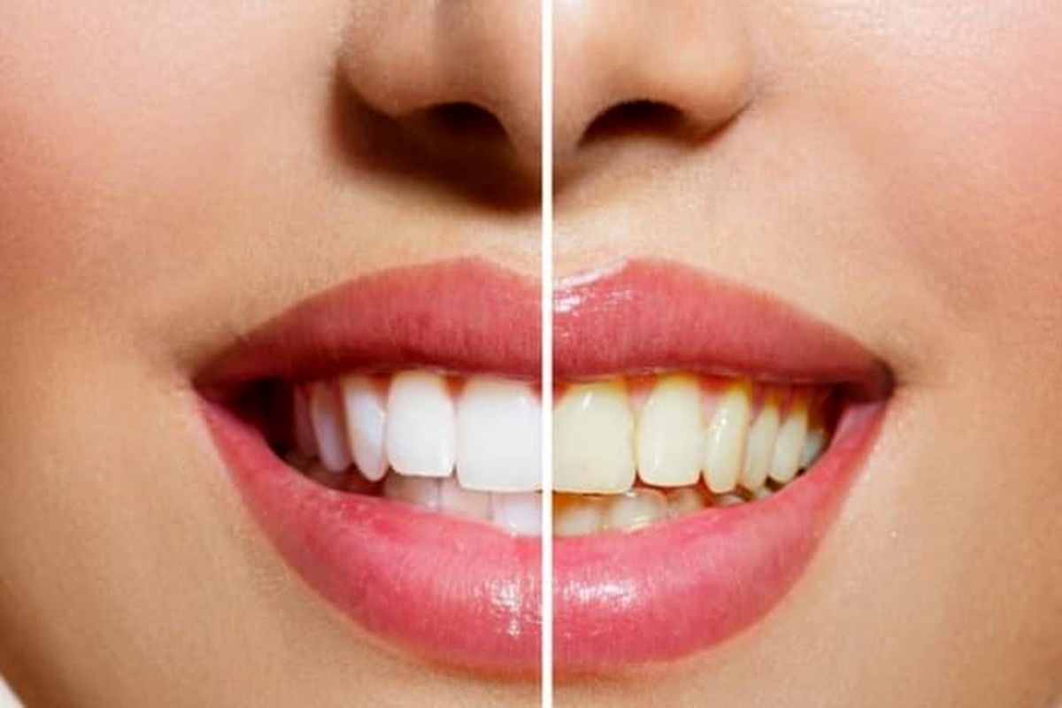عادت‌های غلطی که دندان‌هایتان را زرد می‌کند