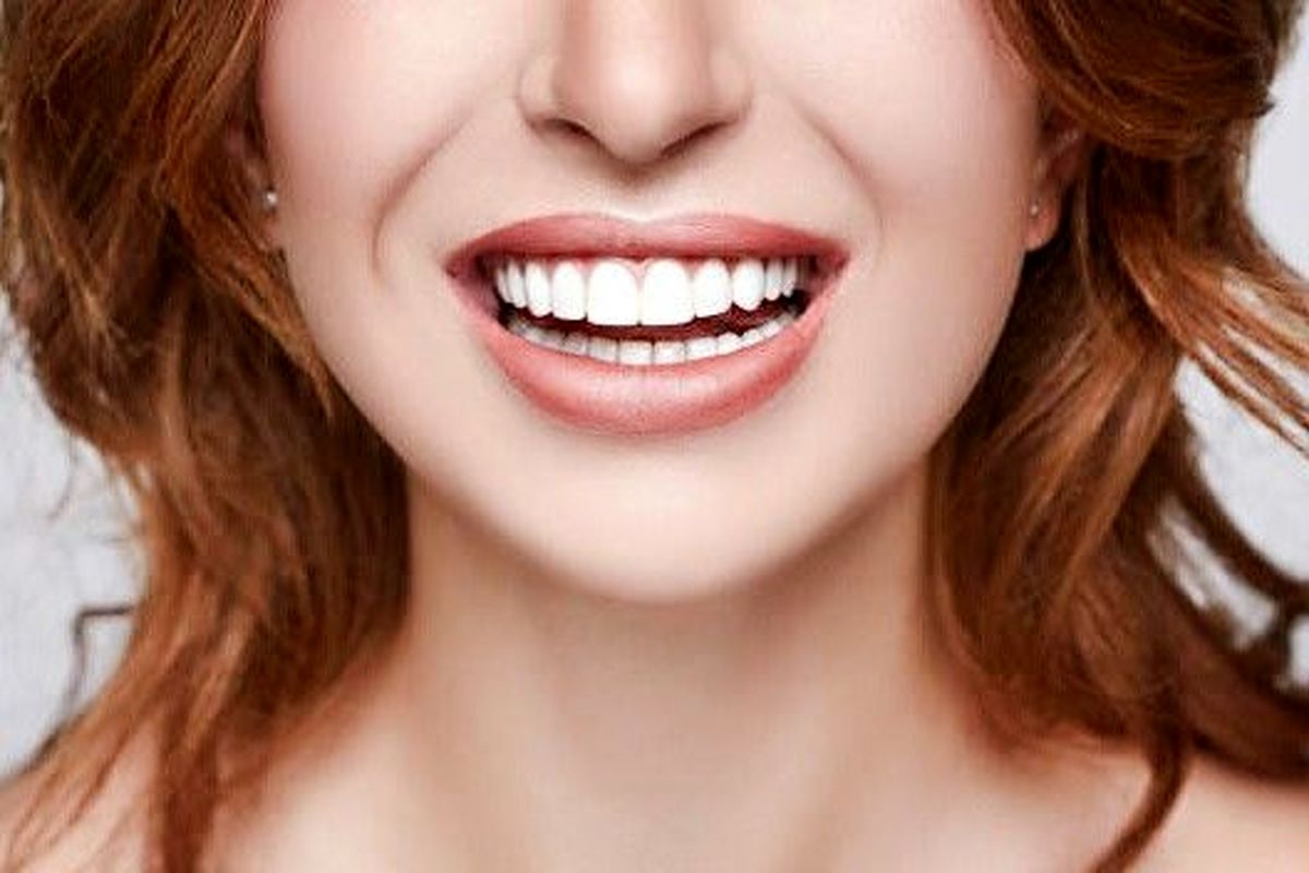 کامپوزیت دندان بهتر است یا لمینت؟