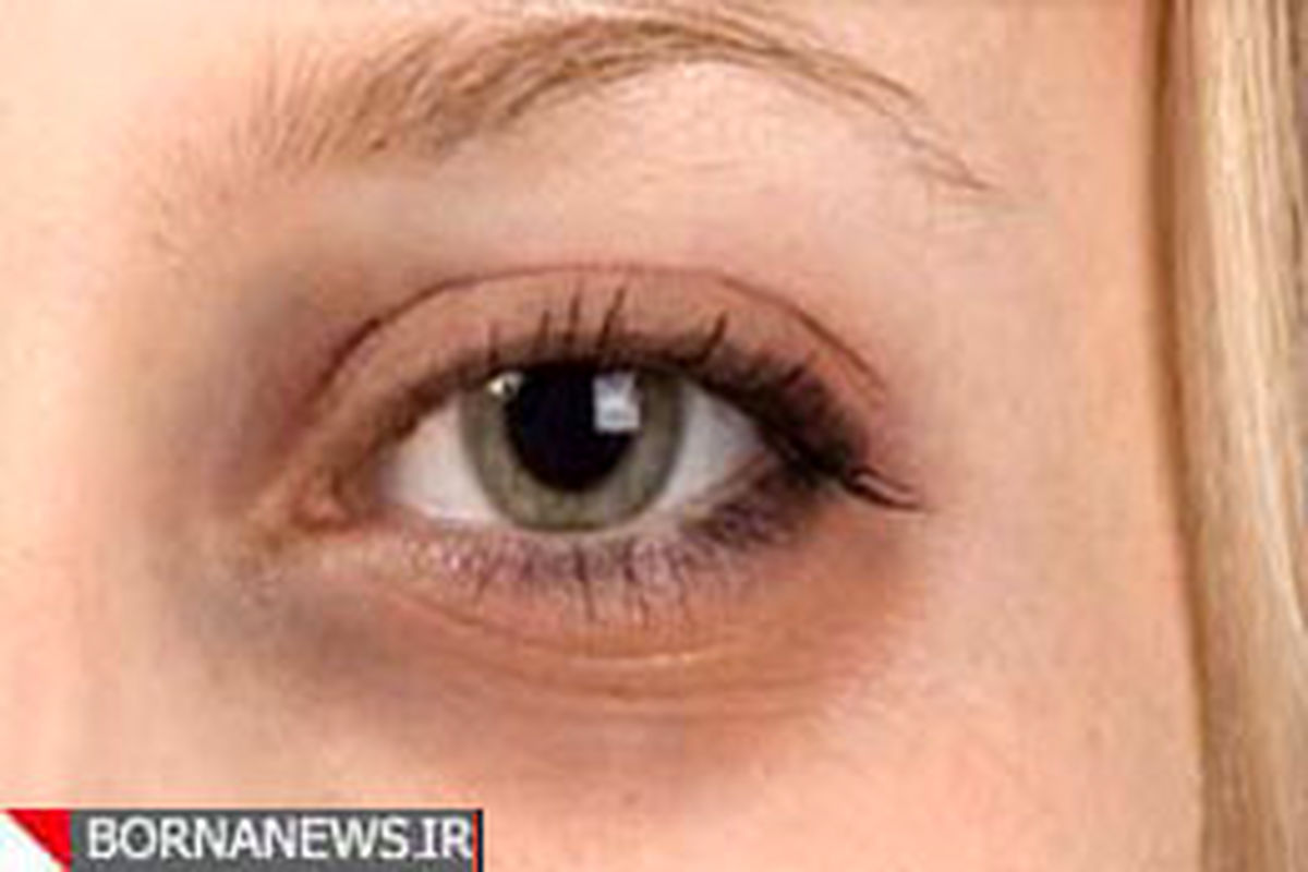 راهکارهایی برای مهار تیرگی دور چشم