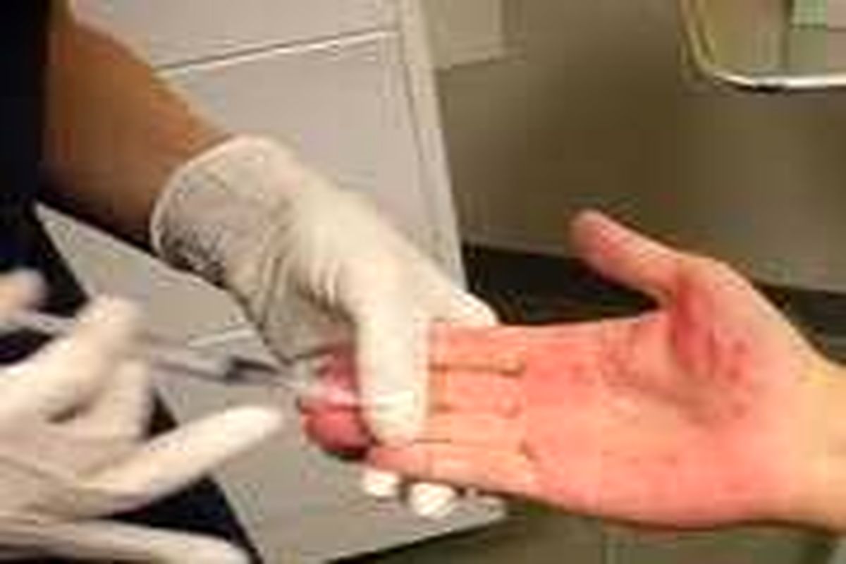 علل و روش درمان خیس شدن مکرر دست ها از عرق