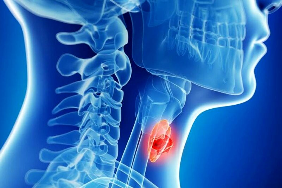 چند میلیون نفر در دنیا تیروئید دارند؟