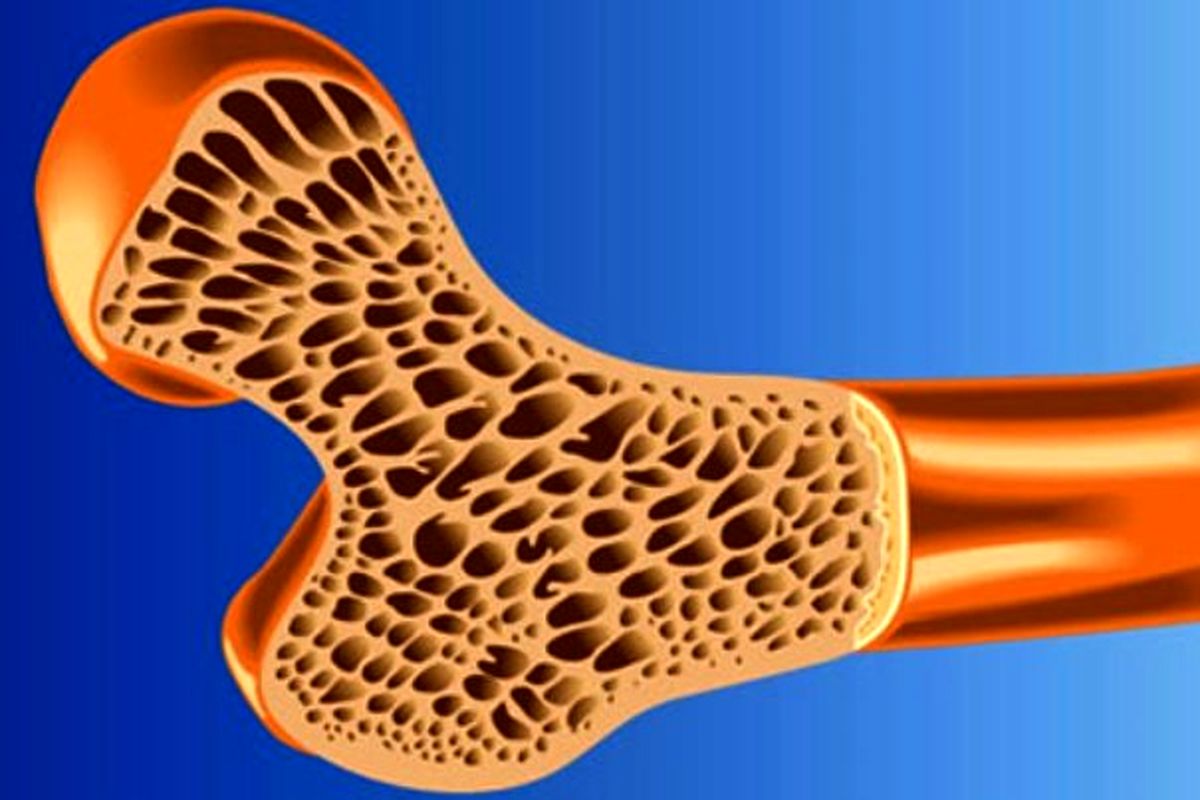 زنان بیشتر از مردان از پوکی استخوان رنج می‌برند