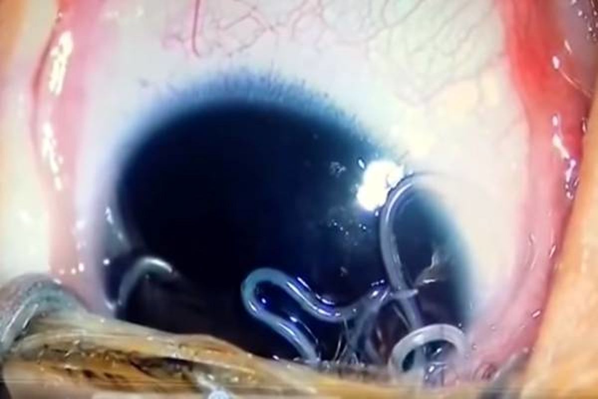 وجود ۱۱ کرم چندش‌آور از چشم نوزاد ۵ ماهه ! + عکس