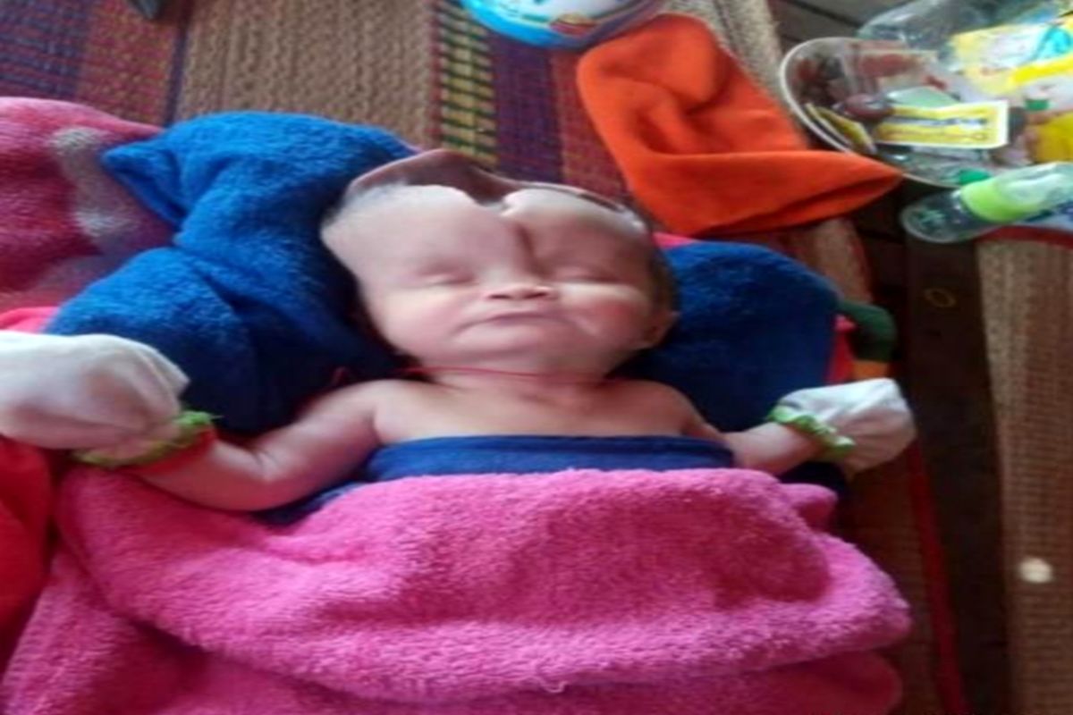 تولد نوزادی عجیب با شکافی ترسناک روی جمجمه‌اش!+  عکس