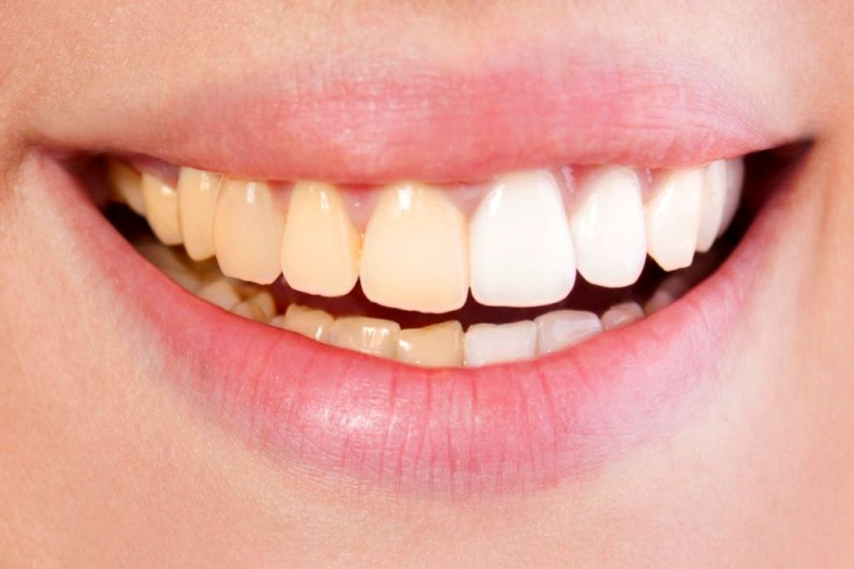 چه عادت‌های غلطی باعث تغییر رنگ دندان‌ها می‌شوند؟