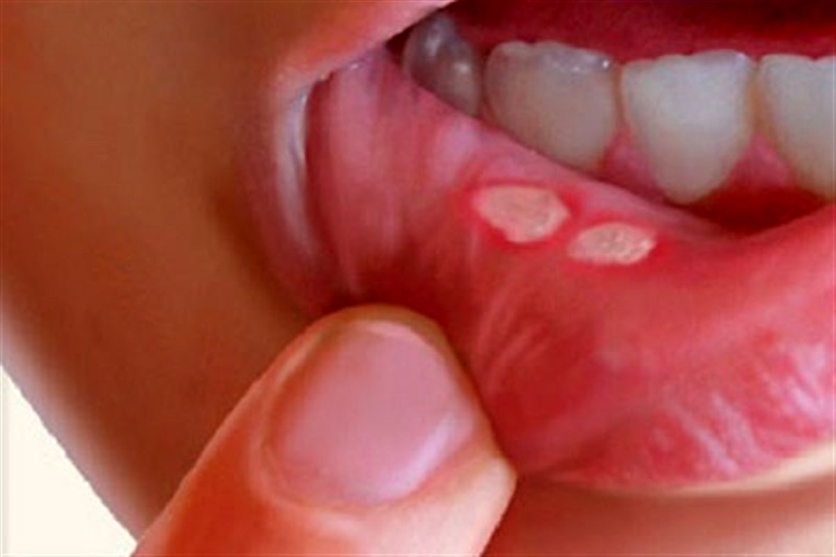 راهکار های خانگی موثر برای درمان آفت دهان