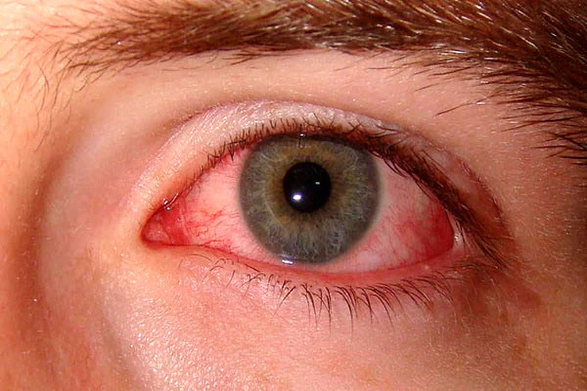 درمان خانگی برای رفع قرمزی چشم