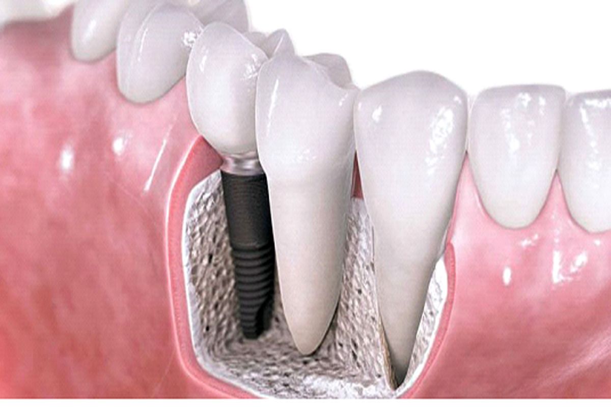 مهم‌ترین راه کاهش عوارض ایمپلنت دندان چیست؟