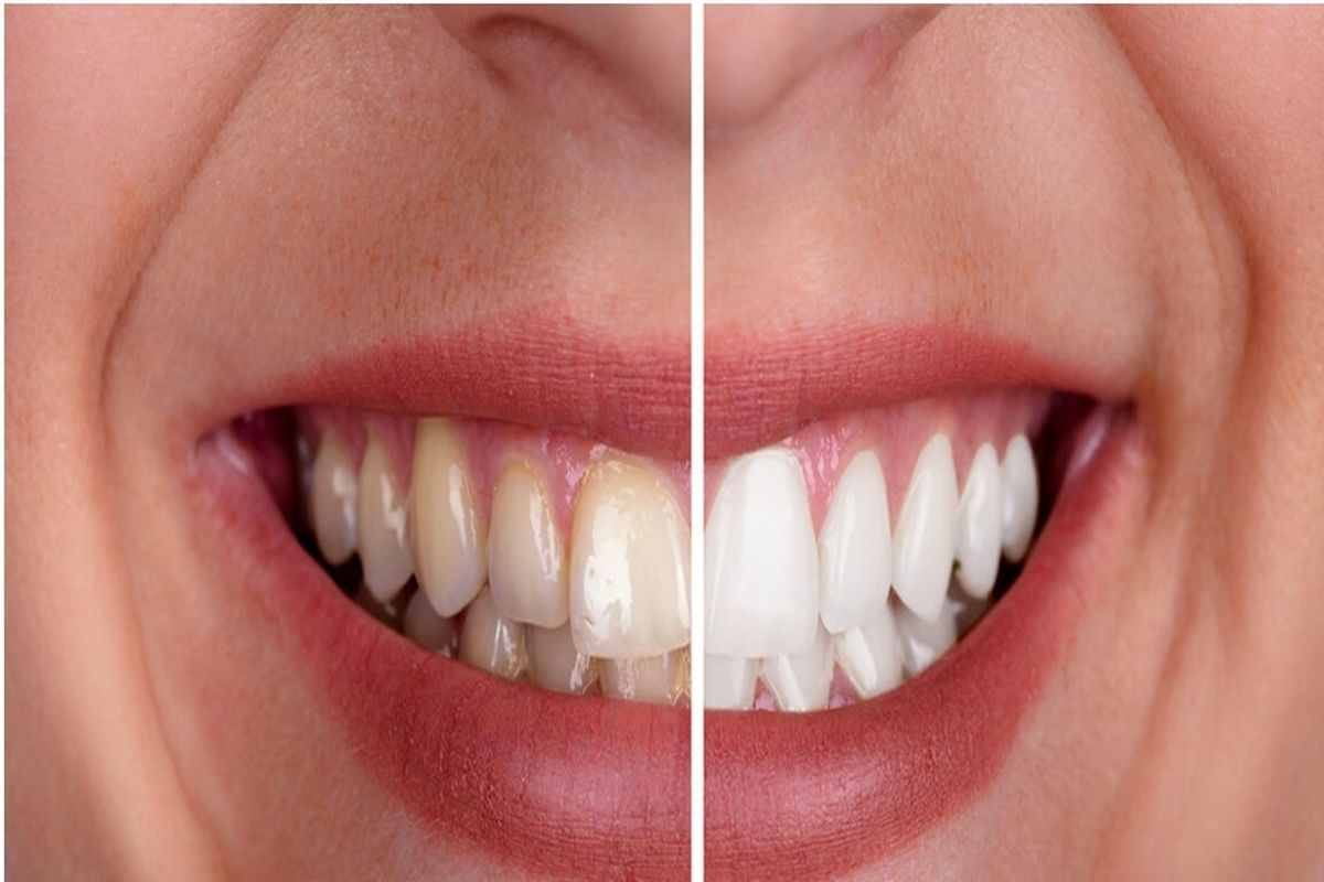 ۶ روش ساده سفید کردن دندان در دندانپزشکی و در خانه