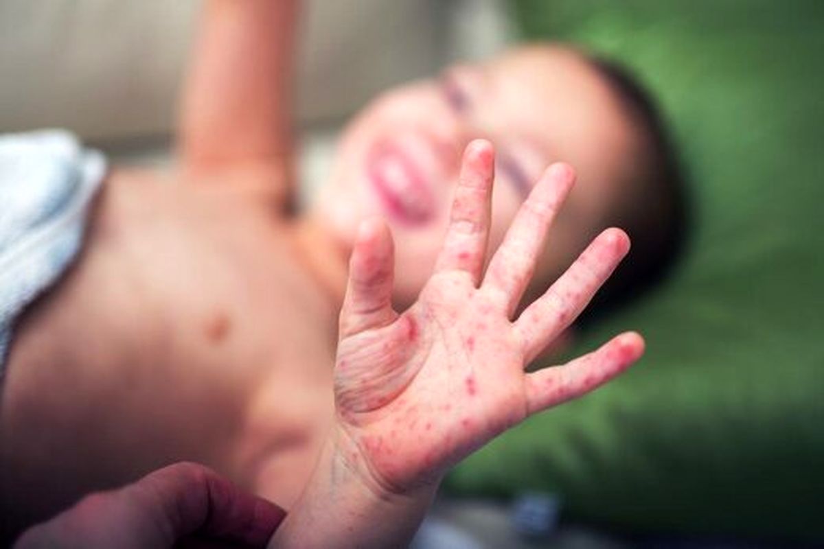 بیماری نادر «دست،پا و دهان» در کودکان