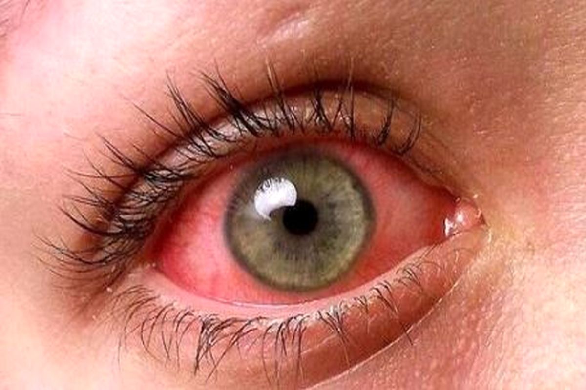 چگونه آلزایمر را روی چشم تشخیص دهیم؟