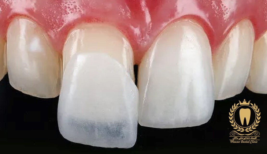 مزایای انجام لمینت دندان مزایای انجام لمینت دندان