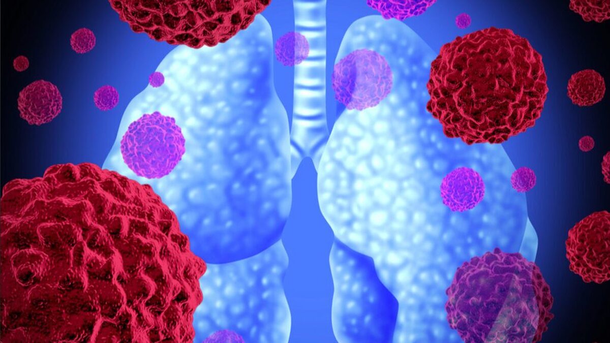 تشخیص سرطان ریه با استنشاق نانوذرات ممکن شد