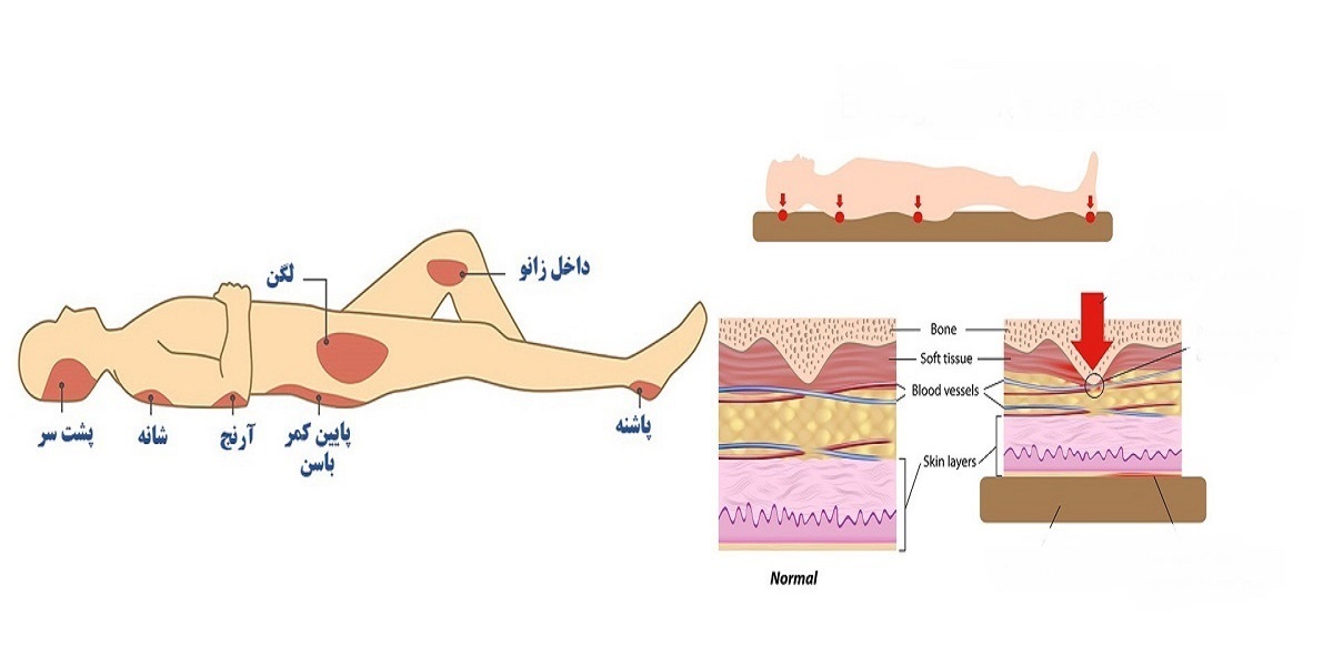 حسگرهای دیجیتالی در خدمت درمان زخم بستر