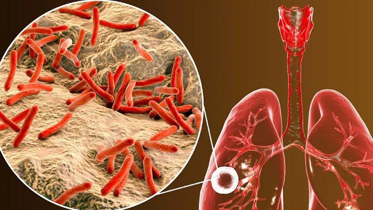 نانوذرات پرشده با آنتی‌بیوتیک بیماری سل را موثرتر درمان می‌کند